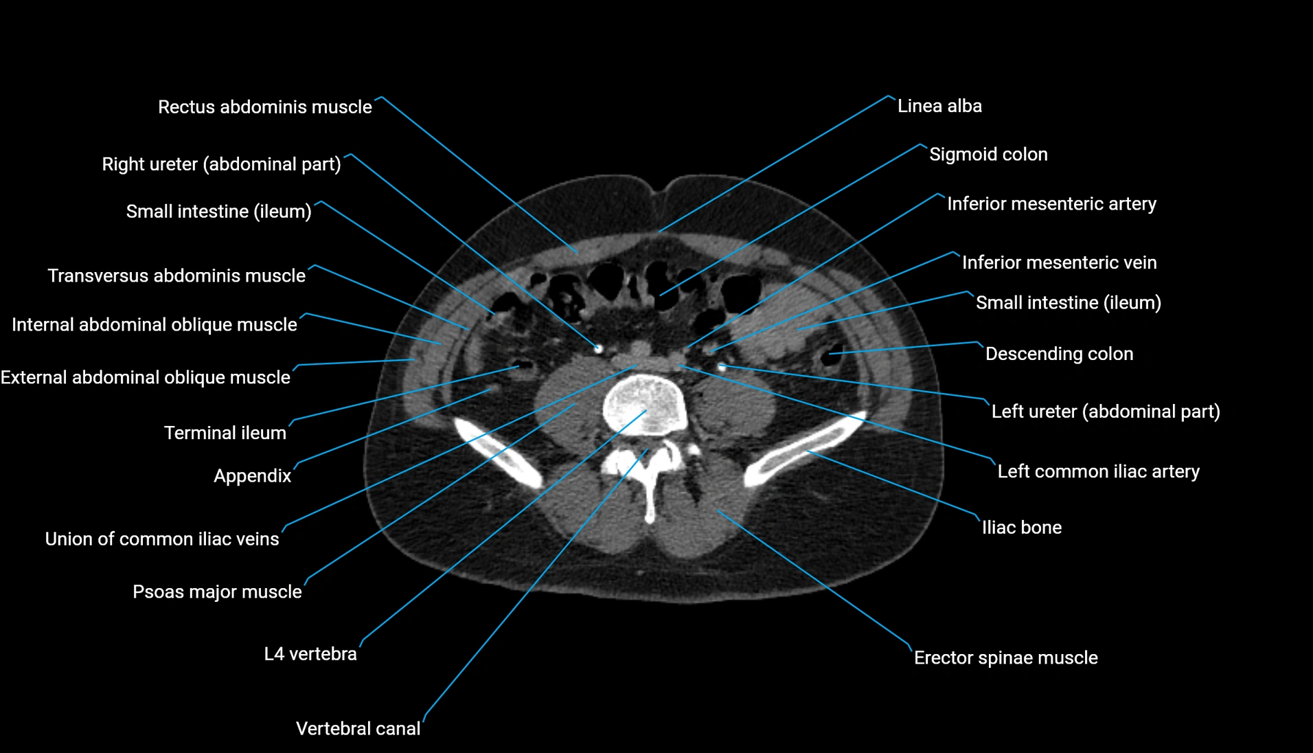 CT urogram axial cross sectional anatomy  labelled radiology image-00157.webp